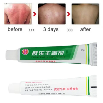 3tk/palju FULEWANG Naha Dermatiit Psoriaas Cream Eczematoid Ekseem Salvi Ravi Psoriaasi Kreem 15g