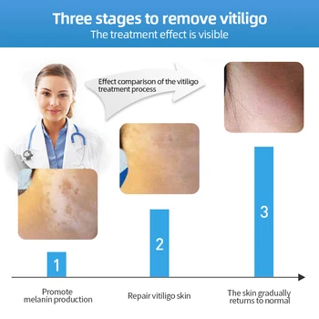 Hiina Meditsiini-Valge Spot Repair Kreemi Pigment Melaniini Edendamine Liniment Naha Vitiligo Leukoplakia Haiguse Ravi