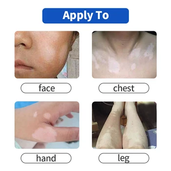 Hiina Meditsiini-Valge Spot Repair Kreemi Pigment Melaniini Edendamine Liniment Naha Vitiligo Leukoplakia Haiguse Ravi